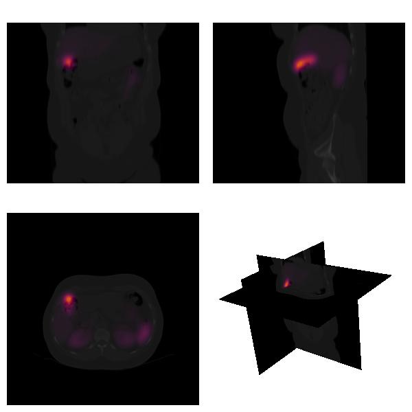 Applications in SPECT/CT registration and fusion Example Three slices (coronal, sagittal