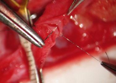 Maximum magnification is crucial for performing delicate anastomoses. For extremely precise movement in the XY plane: the OPMI head travels into the desired position in a matter of seconds.