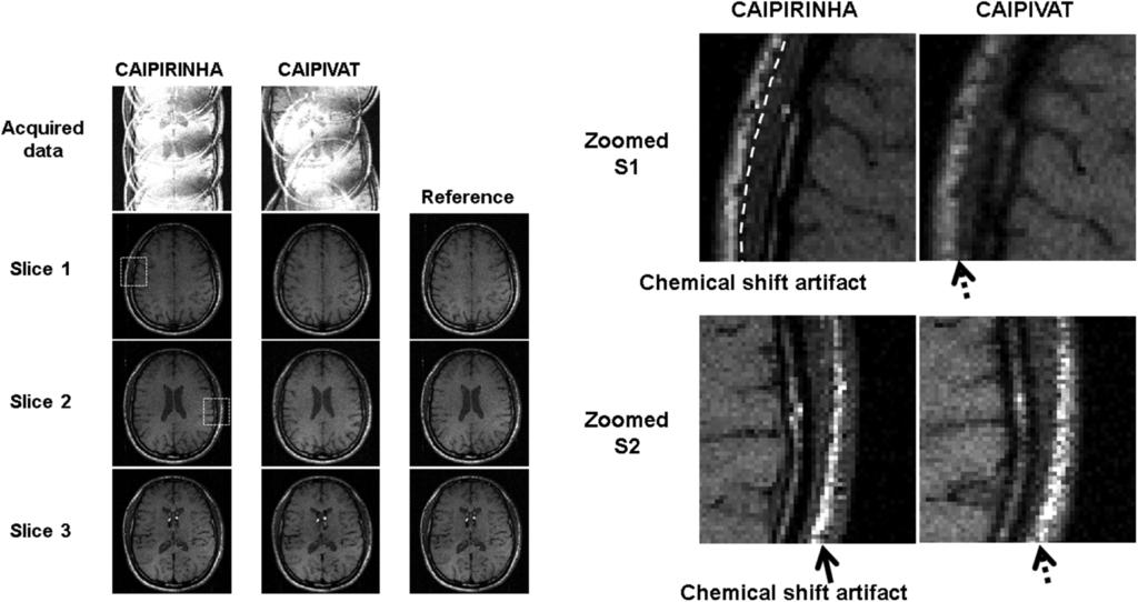Figure 5. In vivo brain experiment results using CAIPIRINHA and CAIPIVAT. Standard SE images are shown in the third column for reference.