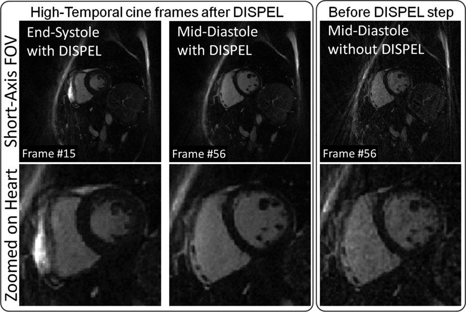 3460 Kawaji et al.: High-temporal resolution cine-cmr with DISPEL and MoPS 3460 FIG. 9. Still frames at end-systole (left column) and mid-diastole (middle column) from the attached video S2.
