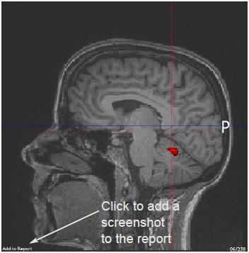 Figure 30: Adding a screenshot by clicking on Add to report in the MPR views and the 3D viewer. You can add an appendix to the end of the report by clicking on the Add appendix button.