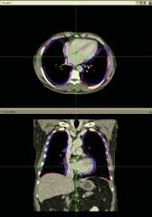 The results of lung surface registration (a) after initial registration in 3D view (b) after initial registration in axial and coronal view (c) after surface