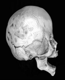 Deformed Infants Skulls Normal Sagittal Synostosis Bicoronal Synostosis Metopic Coronal