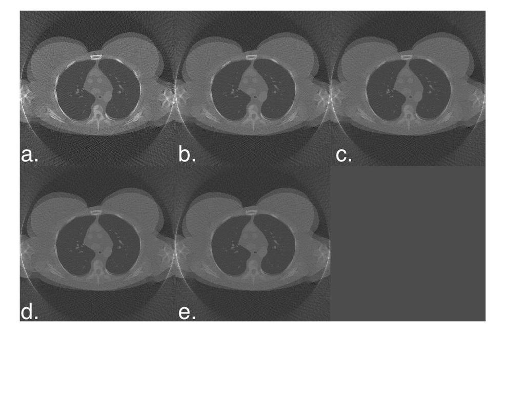 Figure 41: Reconstructed CT images for Female 1 phantom for (a) 60, (b) 80, (c) 100, (d)120, and (e) 140.