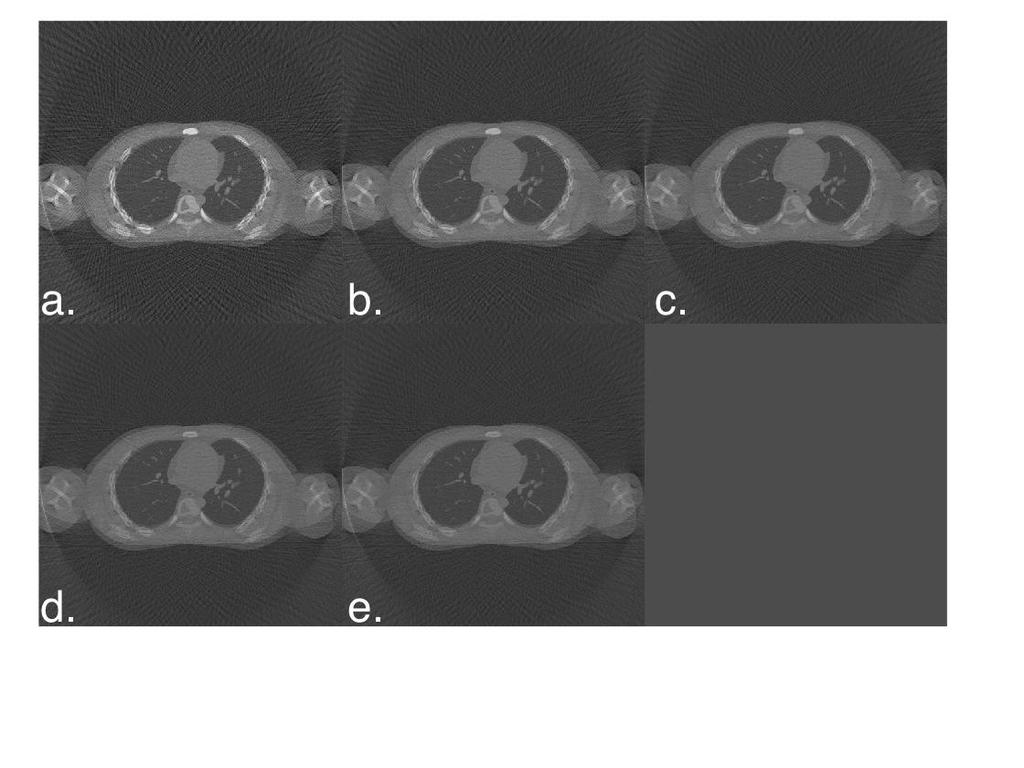 Figure 43: Reconstructed CT images for Male 1 phantom for (a) 60, (b) 80, (c) 100, (d)120, and (e) 140.