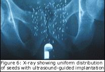 5%-50% interseed attenuation and tissue