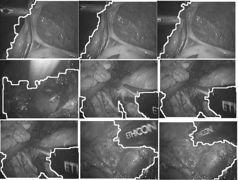 Results on visual salient object detection for gastrointestinal regions, where the white lines indicate the boundaries for the gastrointestinal regions. Fig. 6. videos.