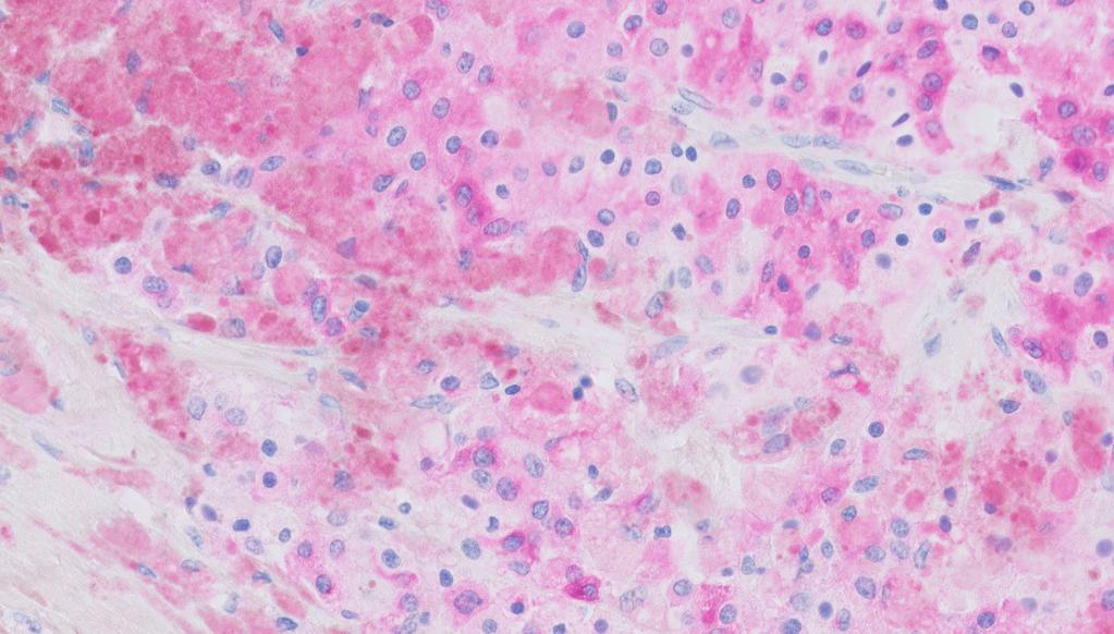 complementary color for your stains. Figure 5. Melanoma, stained with Anti-Melan-A.