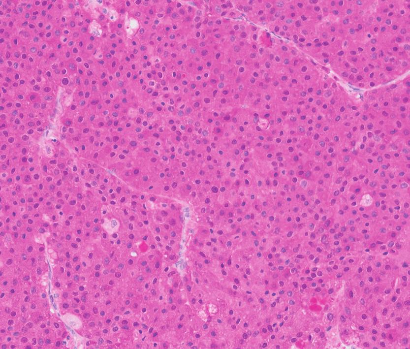 features. Figure 7. Melanoma. Stained with Anti-S100. Figure 8.