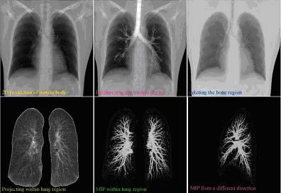 6 algorithm to scan the whole lung region and detect the lung cancer regions, using three algorithms for scanning blood vessel, trachea, and parenchyma regions seems to be more effective. Fig.
