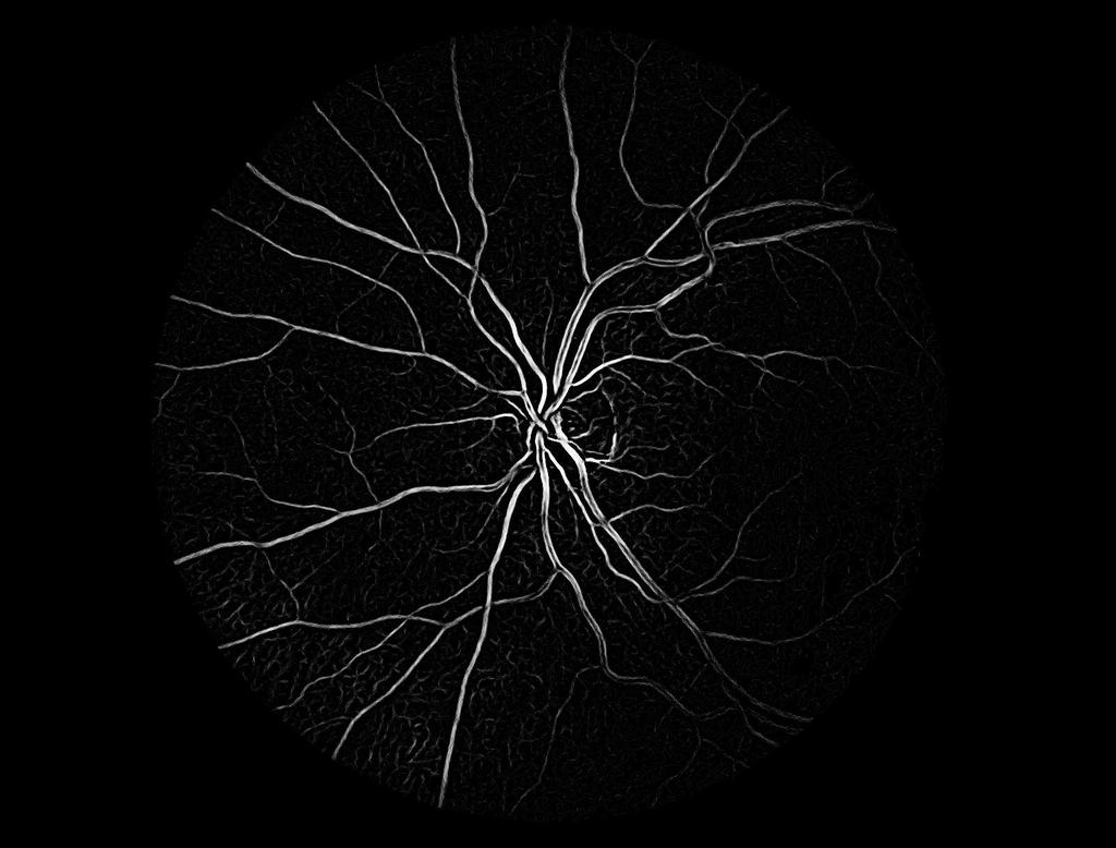 Vessel Segmentation in Fundus Images 263 2.2 Neighbourhood Analysis The Hessian matrix of the 3 3 neighbourhood for each pixel of the image are calculated.