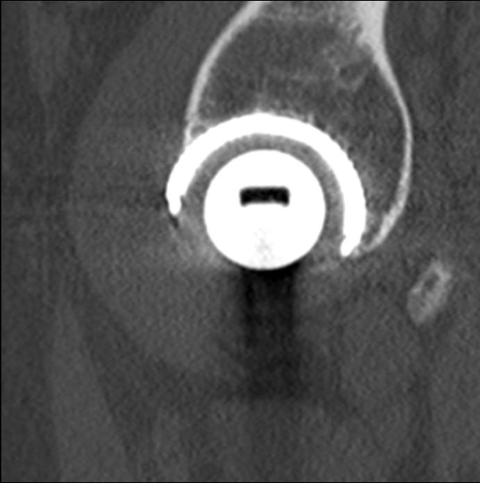 Postoperative CT Metal Implants CT