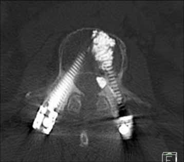 Metal Implants degrade CT images