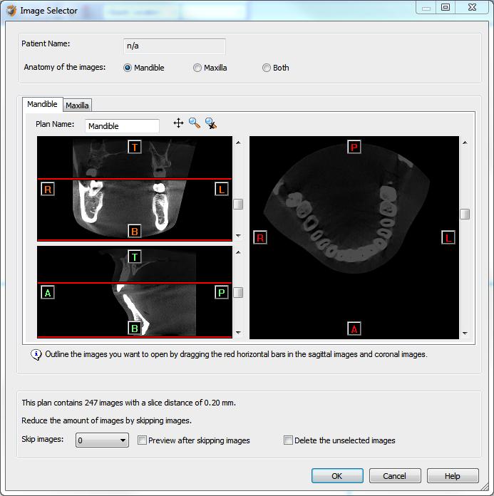 In order to reduce software load, you can REMOVE UNNECESSARY IMAGES from the start or the end of the frame set by dragging the red lines in the coronal and sagittal view.
