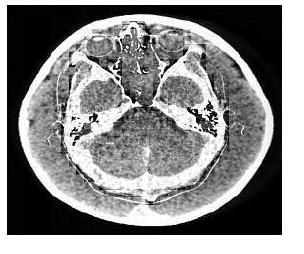 (a) CT image; (b) MRI image; (c) fused image of DWT; Table IV.