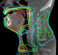 Dose Mapping Pouliot / UCSF CBCT day n CBCT day m Dose Mapping Pouliot / UCSF