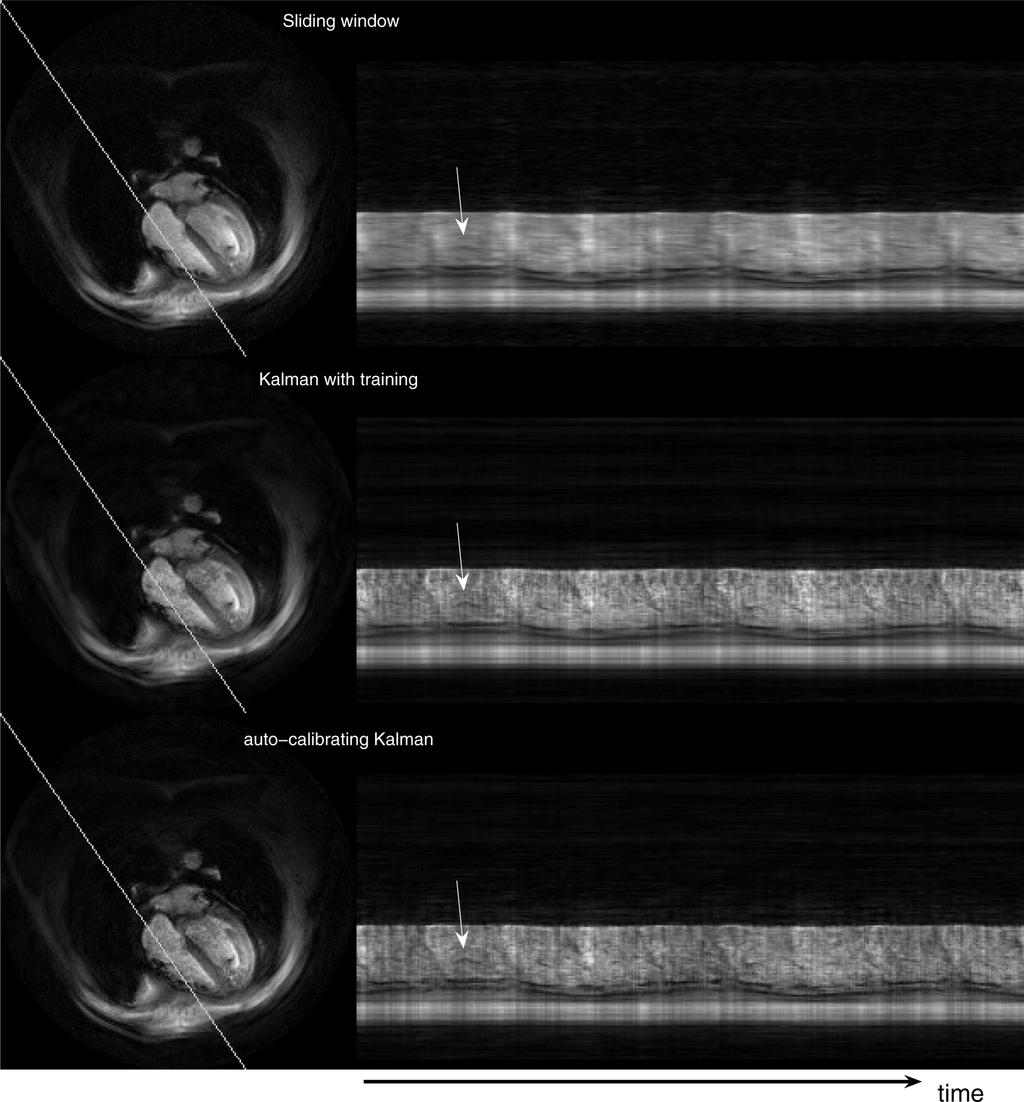 2046 IEEE TRANSACTIONS ON MEDICAL IMAGING, VOL. 28, NO. 12, DECEMBER 2009 Fig. 3. Temporal variation of the oblique line shown on the left side for the three reconstructions.