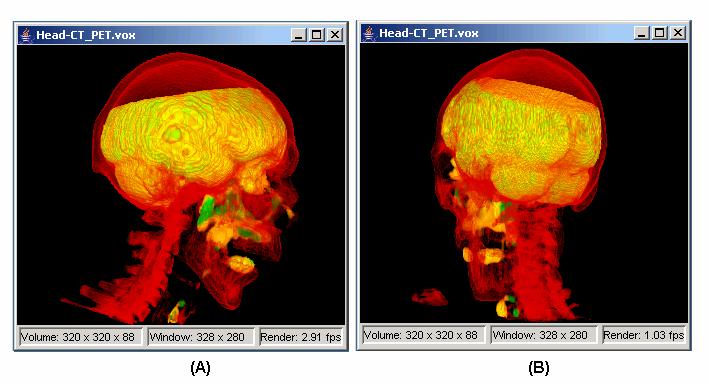 Global positioning error found in the 3P registration (A) and corrected by the 3D registration (B). CT (red) and MR (green) are used.