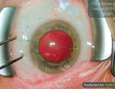 Your benefits for Anterior Surgery As an anterior surgeon you rely on red reflex as it provides ideal contrast to visualize the posterior capsule, lens and anterior chamber structure.