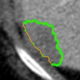 gray line) that describes the correct border of the lesion; (b) some part of the initial contour has been replaced by the new contour that has been generated from the user contour by moving seed