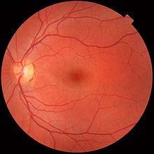 Retinal Scan Cataracts and pregnancy change retina pattern.