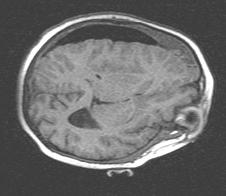 (a) (b) (c) (d) Fig. 4. Elastic matching applied to MR scan of the brain obtained during neurosurgery.