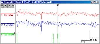 prescribed to be detected. The position of the block in data can be noted in this example by observing the EEG. 9 Blocks may overlap.
