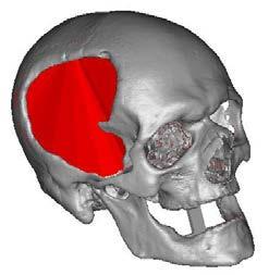 Creation of the cranioplasty