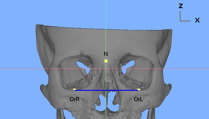 line six degrees above the horizontal plane S at the origin (a) 3D view. (b) Anterior view: OrR and OrL are at the same height. (c) Superior view: the S-N line is positioned in the midsagittal plane.