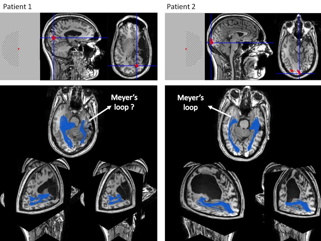 Figure 6 The same approach of scoring optic radiation fiber tracts as in Figure 3, only this time applied on difficult cases, where the neural anatomy of patients differs dramatically from the