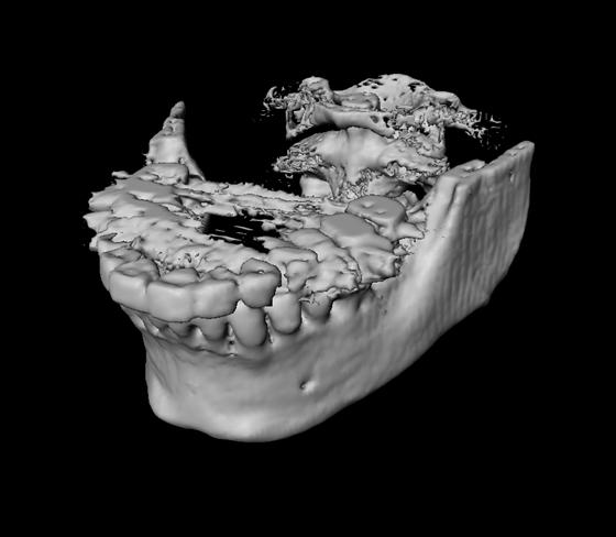 of a CT scan without metal artifacts d) Volume