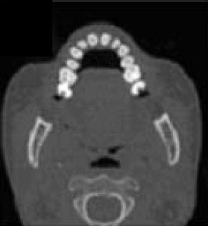 4.3.2.2 Segmentation of Teeth in CT Volumetric Dataset by Panoramic Projection and Variational Level Set Hosntalab et al.