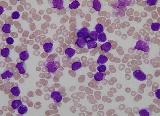 Acute Lymphocytic Leukemia Detection from Blood Microscopic Images Sulaja Sanal M. Tech student, Department of CSE. Sree Budhha College of Engineering for Women Elavumthitta, India Lashma. K Asst.