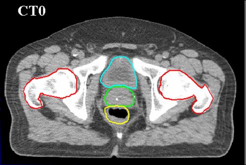 (Daily CT) Prostate Radiotherapy Planning contours mapped