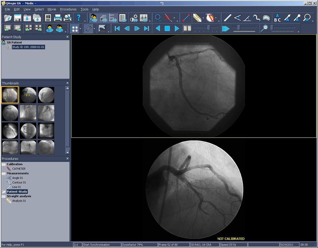 Introduction About QAngio XA QAngio XA is Medis' software solution for the quantification of peripheral and coronary vessels in X- ray angiograms, and for the quantification of X-ray ventriculograms.