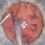 Consistent red reflex during the entire cataract procedure See more with less light Share the benefits with your team Featuring a