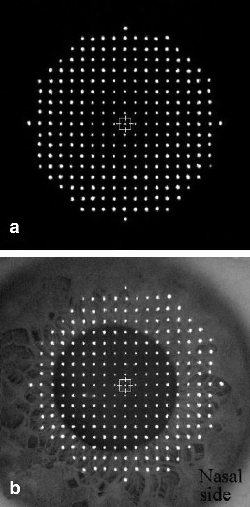 372 Corneal Topographer Based on the Hartmann Test Mejía and Galeano Hartmann pattern are focused. In practice one will see the image of P focused within a square-mire, Fig. 3.