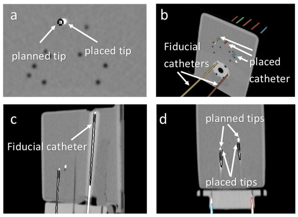 Mehrtash et al. Page 10 Figure 4. The planning CT scan and 3D models of the inserted and fiducial catheters in Experiment 1.