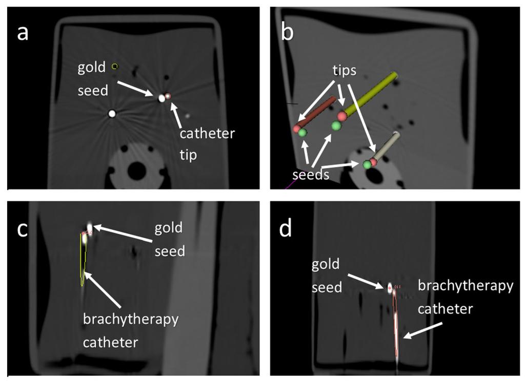 Mehrtash et al. Page 12 Figure 6. Catheter tips and gold seeds in the post-insertion CT for Experiment 2. (a) Axial slice through the phantom CT shows gold seeds and catheter tips clearly.