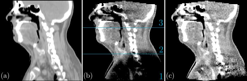 Figure 11. Saggital slice of (a) CT, (b) uncorrected CBCT and (c) shading-corrected CBCT images of a head & neck patient.
