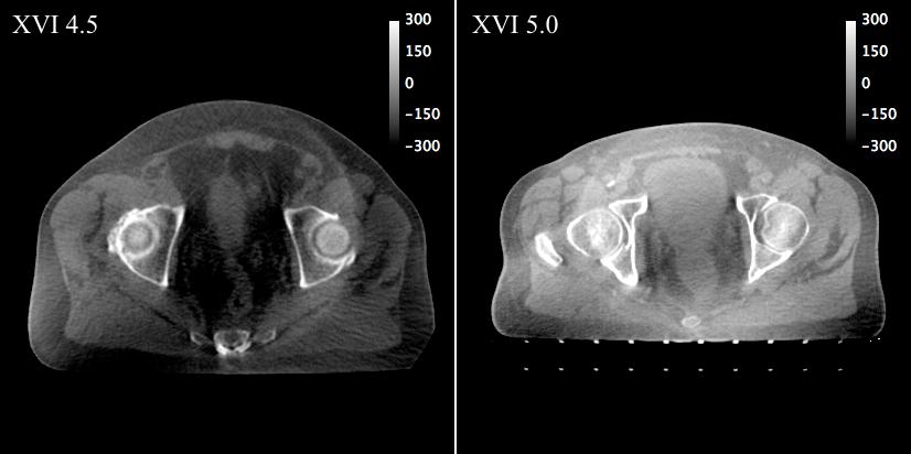 APPENDIX A. XVI 5 IMAGES In a recent update to the Elekta XVI software (XVI 5.0) a correction is applied to the CBCT images during reconstruction.