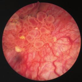 bladder tumor Bladder mucosa, papillary