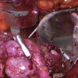 3: Radical prostatectomy Fig. 4: Partial nephrectomy Images courtesy of Prof. med. G.