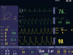 ECG with multi-arrhythmia analysis Viewing, printing and adjustable ST alarm settings for anterior,