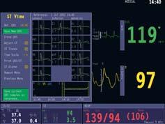 of patient s ischaemic events Fully printable 12-lead diagnostic report EEG, AEP and BIS Up to four