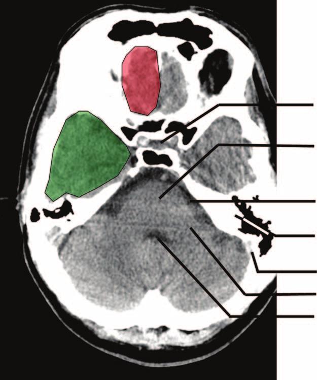 4 ¼ Fourth ventricle 5 ¼ Middle cerebellar peduncle 6 ¼ Sigmoid sinus 7 ¼ Petrous temporal bone and mastoid air cells 8 ¼