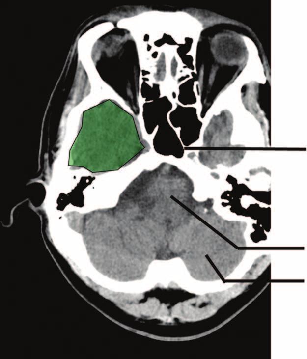 IInterpretation of Emergency Head CT Important anatomical considerations Review of normal anatomy