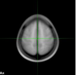 Template normalization using SPM Co-registered MRI " BG.