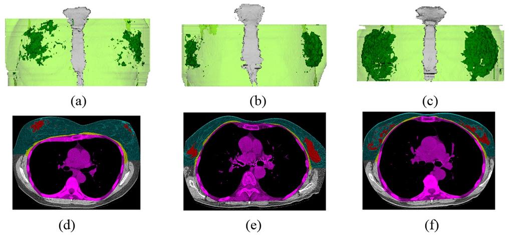 (a) (d) (e) (f) Figure 10. (a-c) 3D coronal visualizations of the whole breast segmentation (in light green) from three different CT scans.