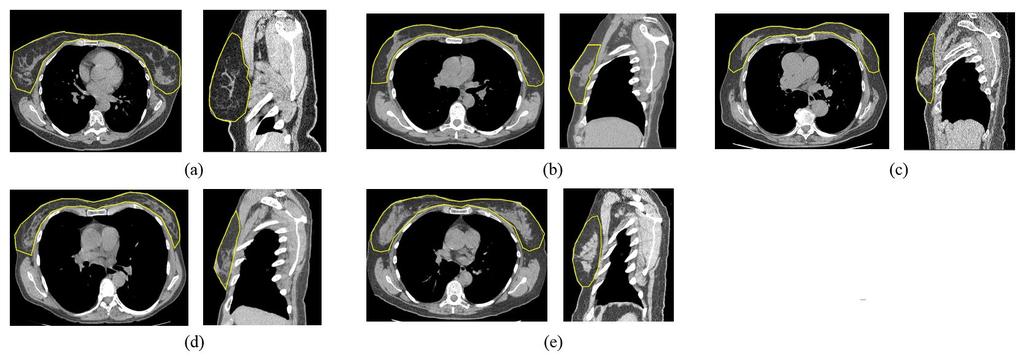 (a) (c) (d) (e) Figure 1. Five examples of breast region with ground truth annotated (indicated by yellow contours) by a radiologist.